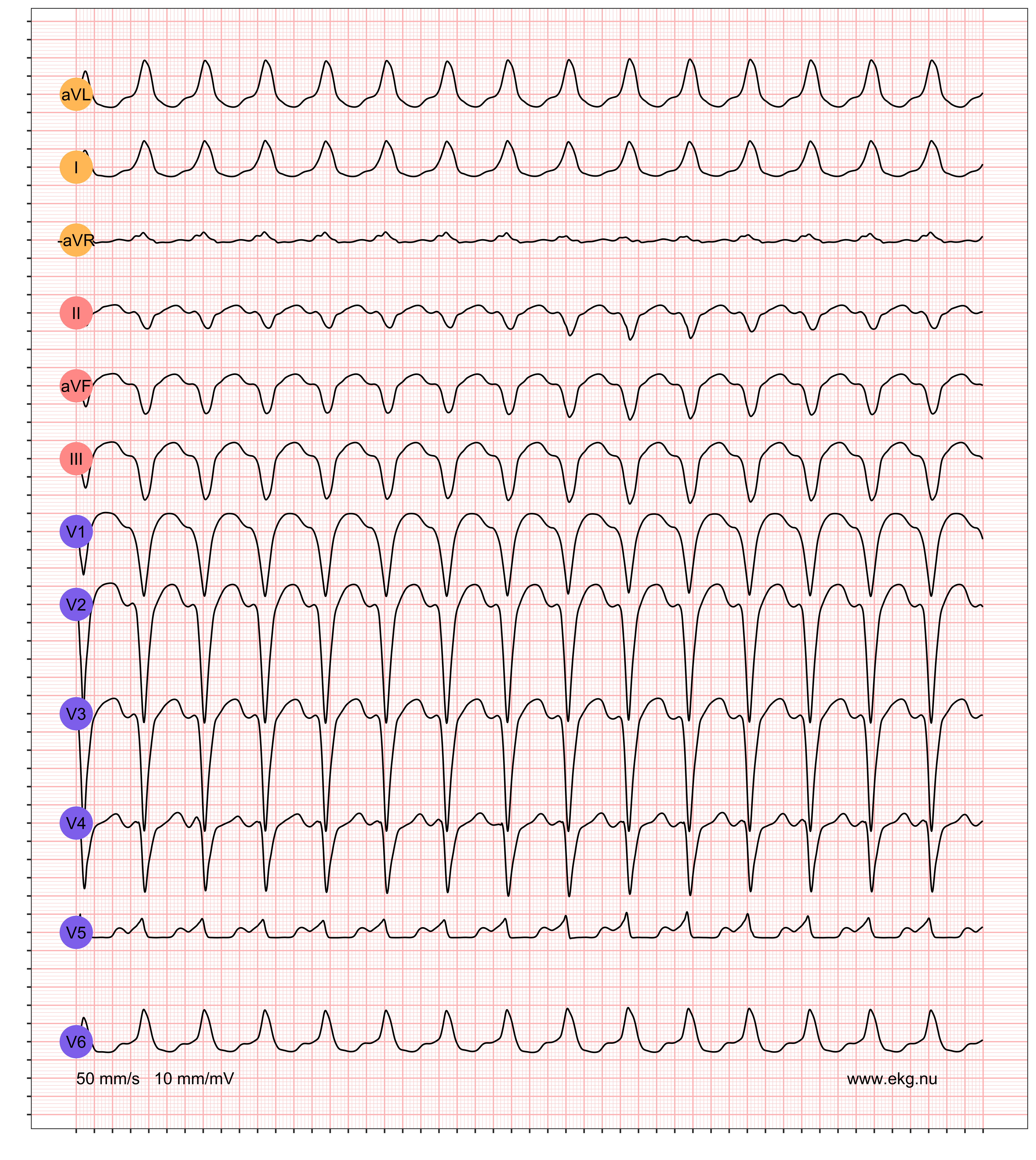EKG exempel 1. Patient med WPW-syndrom (pre-excitation med takyarytmier). Patienten har en känd WPW och detta EKG registreras under en pågående supraventrikulära takyarytmi.