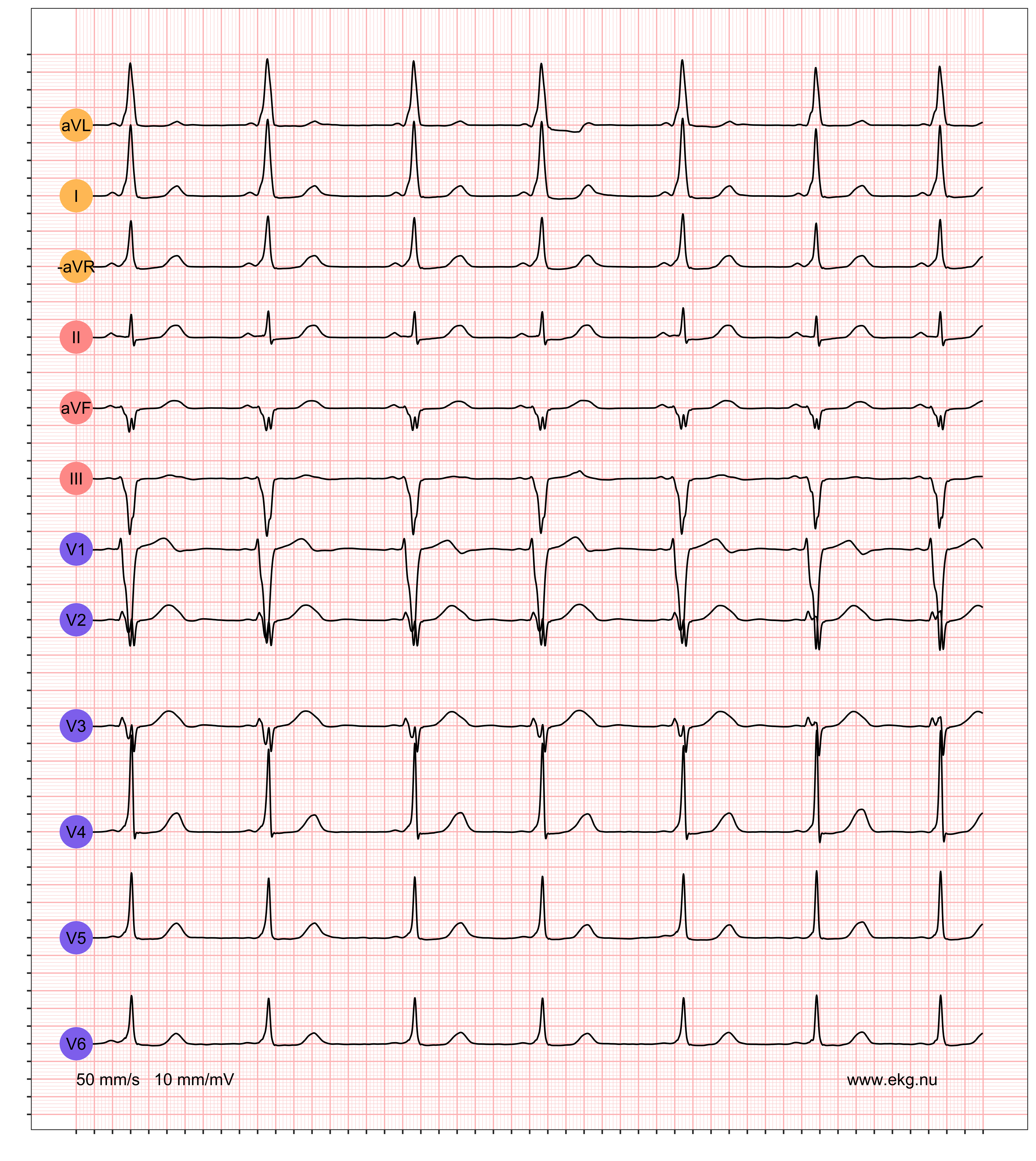 EKG exempel 2. Patient med pre-excitation på vilo-EKG.