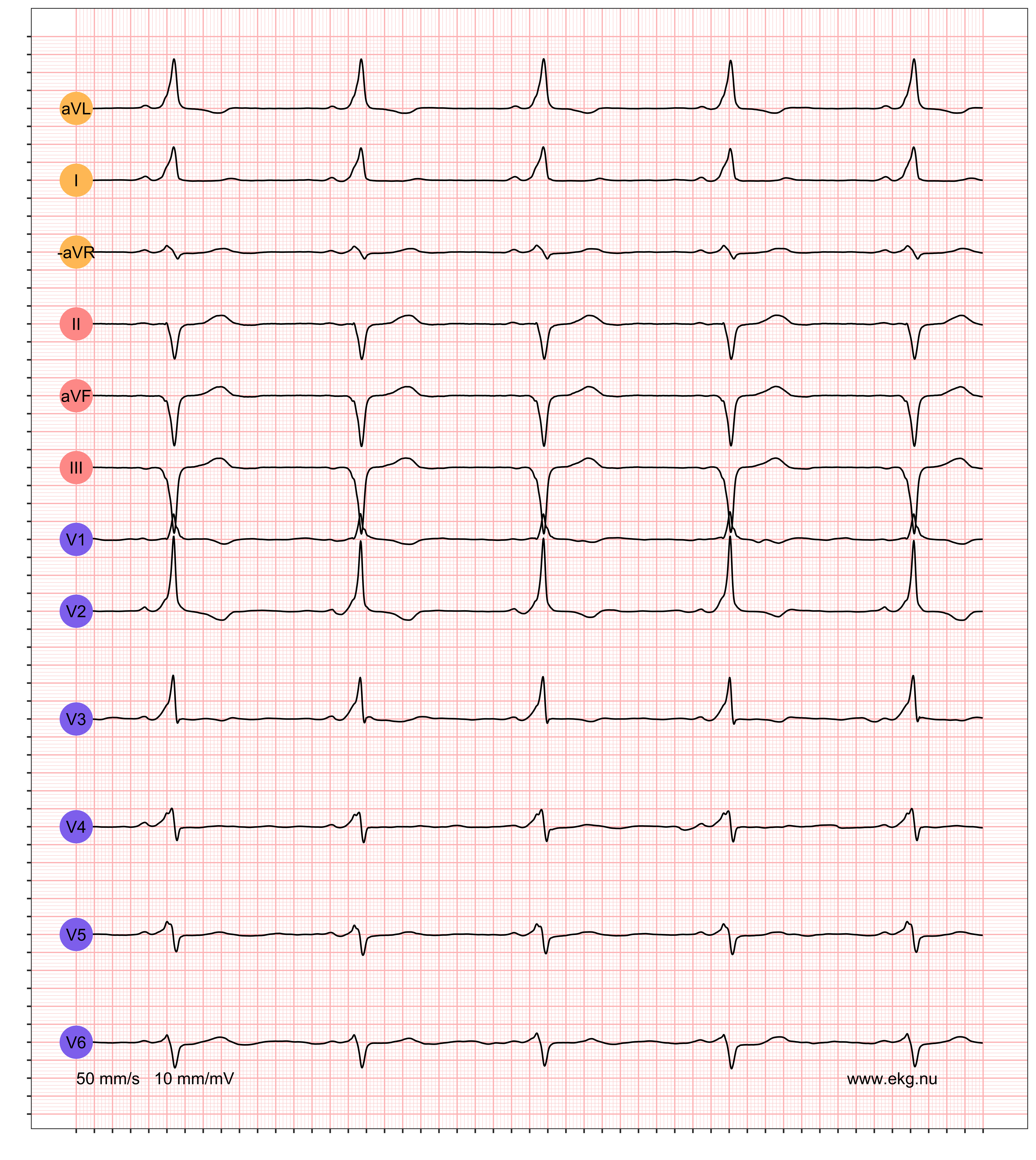 EKG exempel 3. Patient med pre-excitation på vilo-EKG.