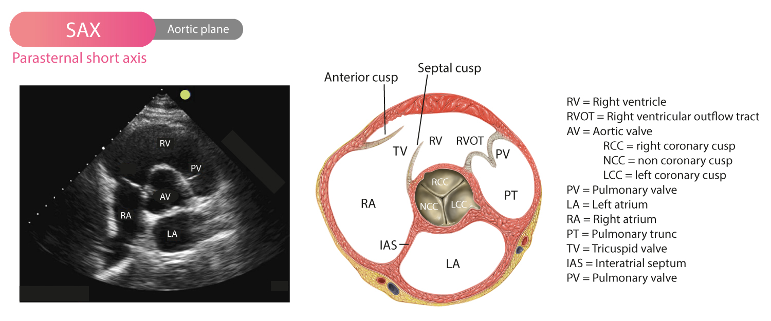 Aortaklaffen visualiserad i PSAX (parasternal kortaxelvy)