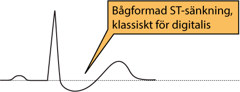 Figur 104. Bågformade ST-sänkningar vid digitalisbehandling.