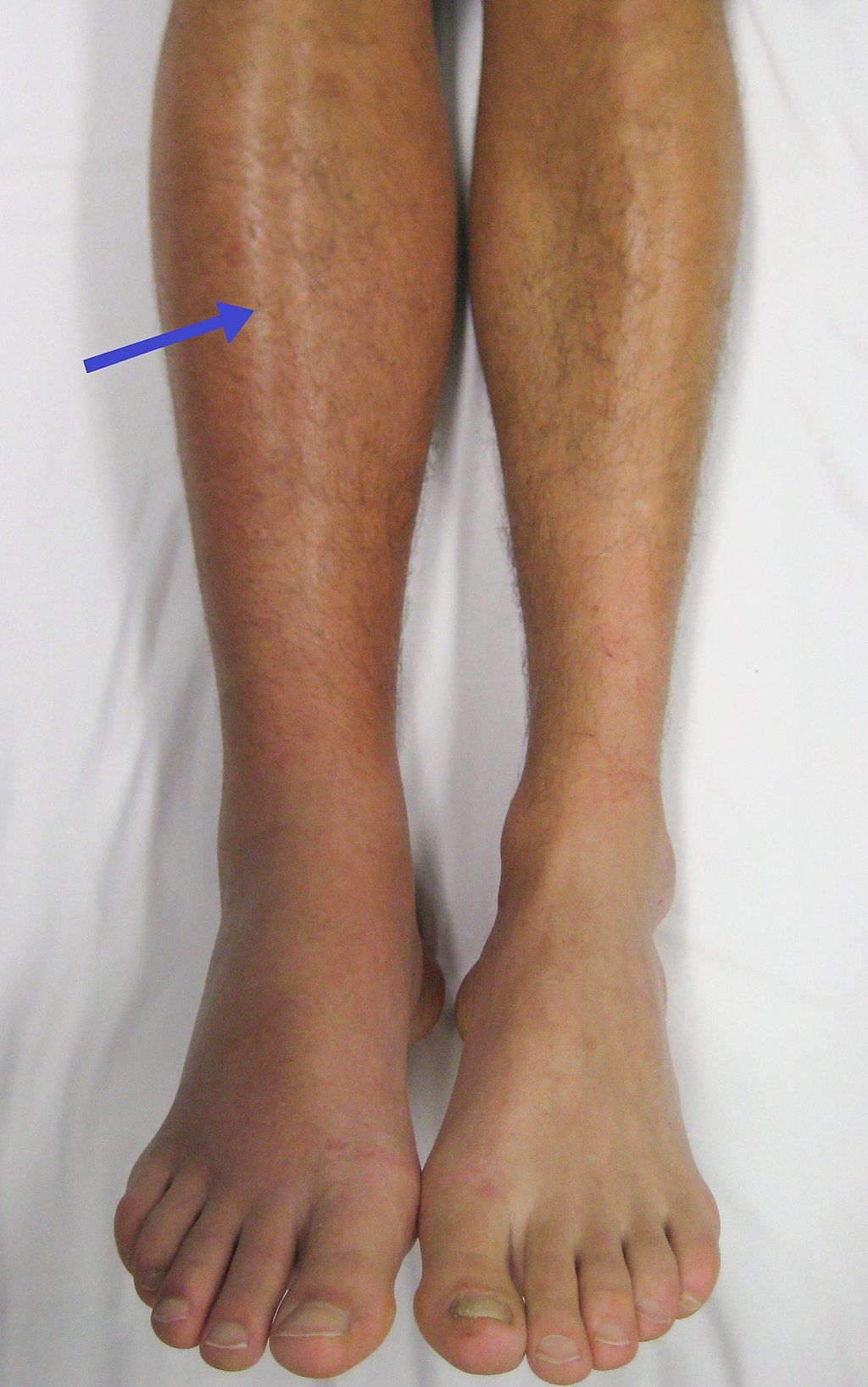 DVT (djup ventrombos)