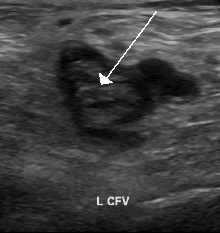 DVT (djup ventrombos) i v. femoralis communis.