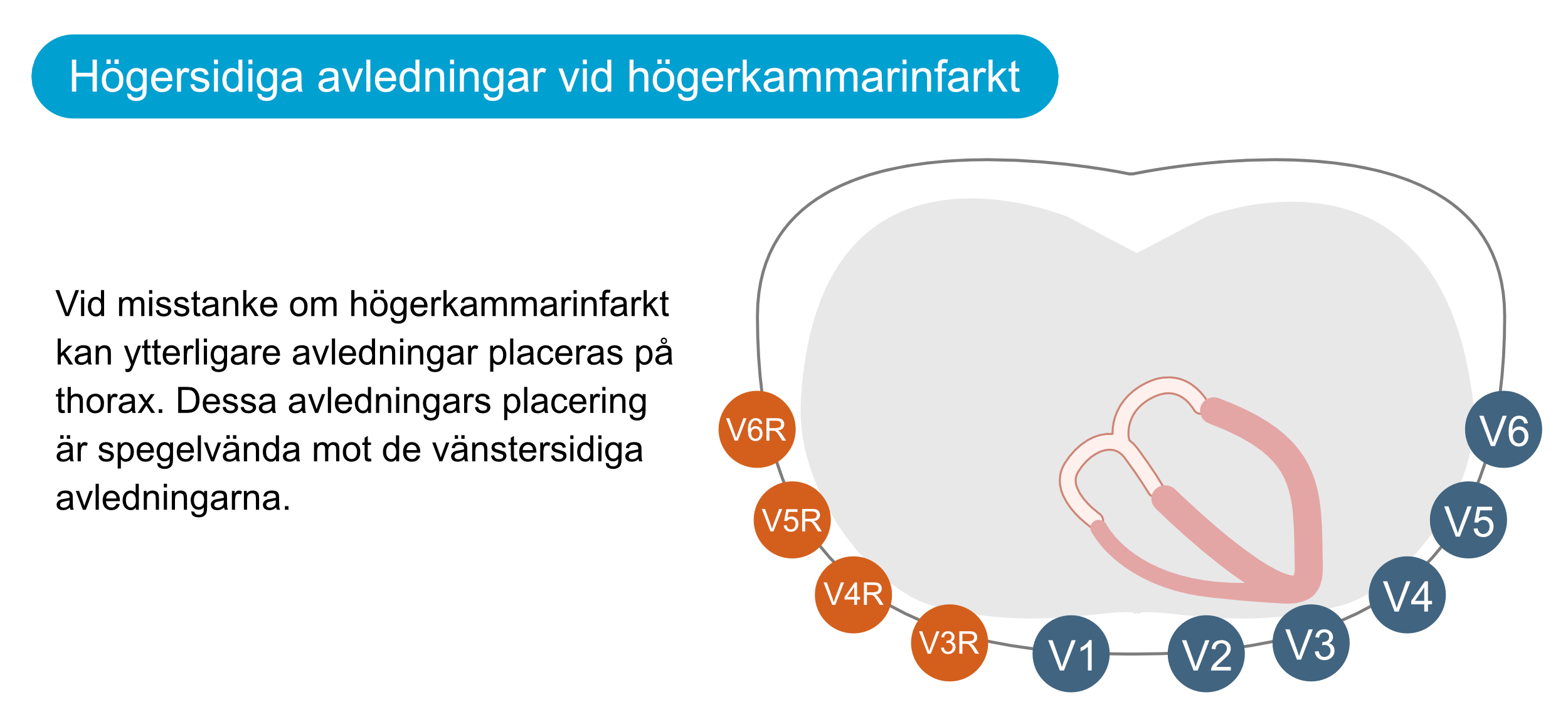 Figur 16. Högersidiga bröstavledningar vid högerkammarinfarkt. Dessa avledningar bör anbringas vid inferior infarkt för att utröna om även höger kammare drabbats.