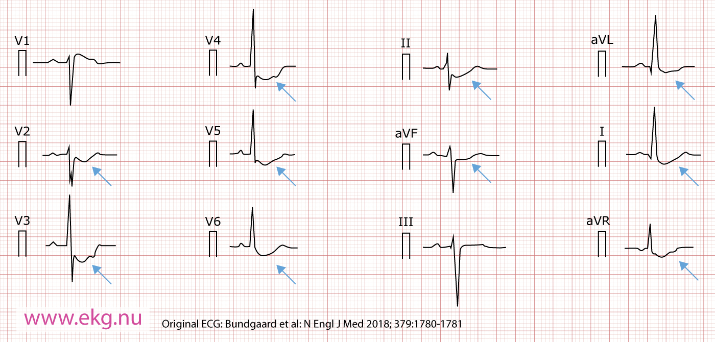 Figur 1. 12-avlednings-EKG från manlig patient, 63 år gammal, med konkava (uppåt) ST-sänkningar i avledning I, II, aVL, aVF, -aVR och V2 till V6. Det ses också ett hack i den uppåtgående delen av ST-sträckan.