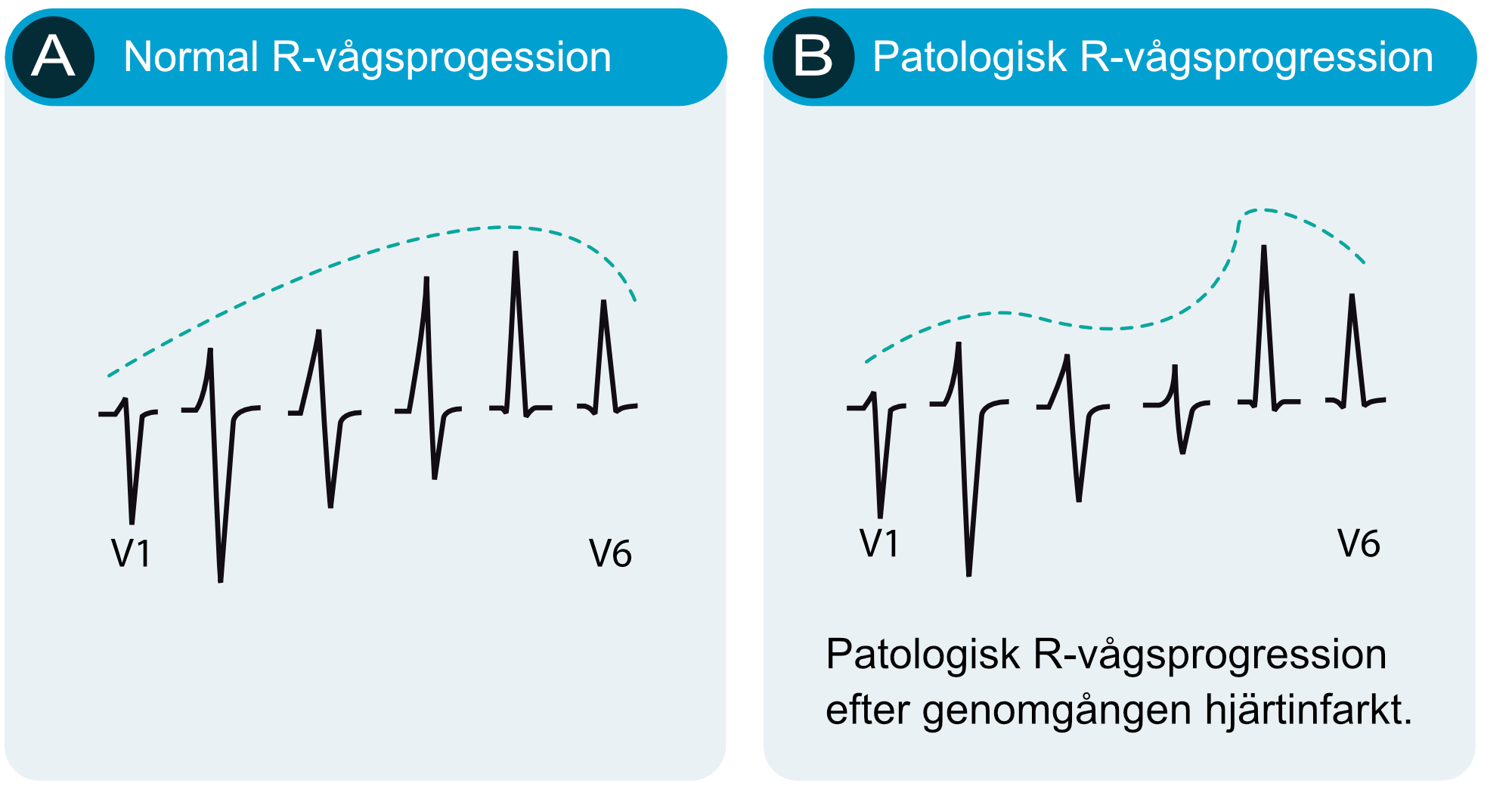 Figur 9. Normal (A) och patologisk (B) R-vågsprogression i V1-V6.
