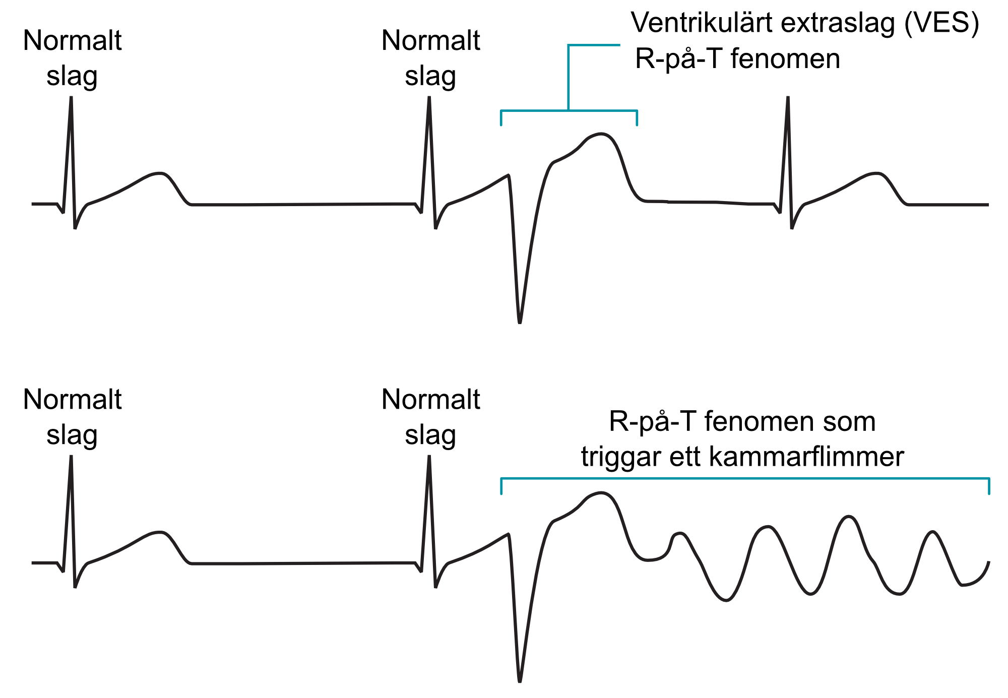 Figur 3. R-på-T fenomen innebär att ett kammarkomplex sammanfaller med T-vågens apex. Detta kan utlösa ett kammarflimmer. Risken för detta är låg men skall beaktas i situationer med ökad risk för kammarflimmer (patienter med akuta koronara syndrom, elektrolytrubbningar, digitalisbehandling, behandling med antiarytmika, kardiomyopatier samt vid genetiska jonkanalsjukdomar).