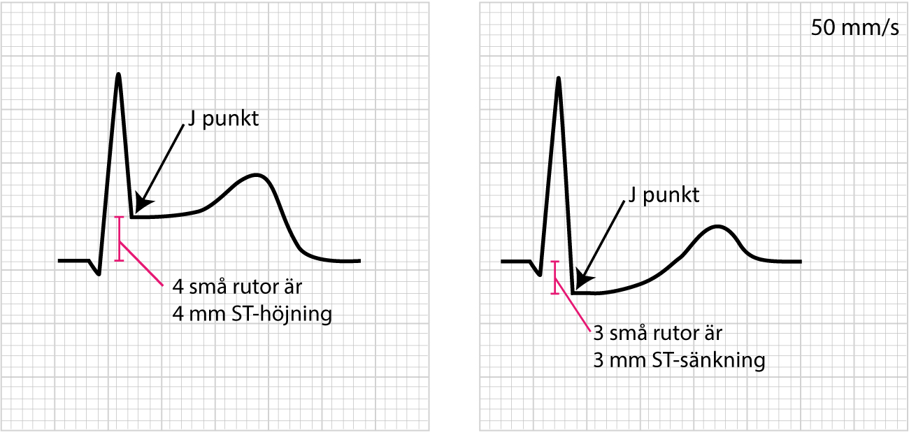 Figur 13. Mätning av ST-höjning och ST-sänkning på EKG.