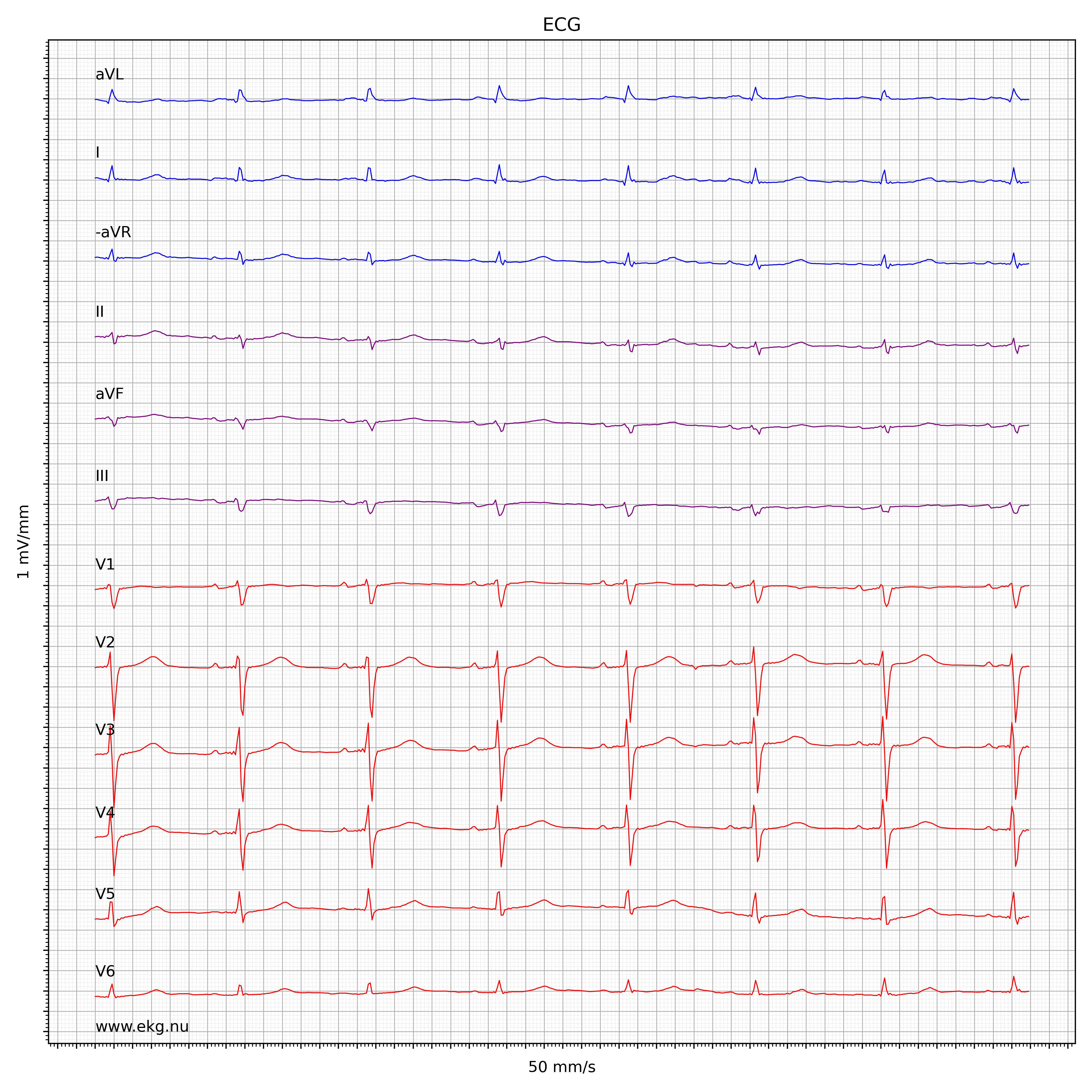 EKG test tolkning 3192161