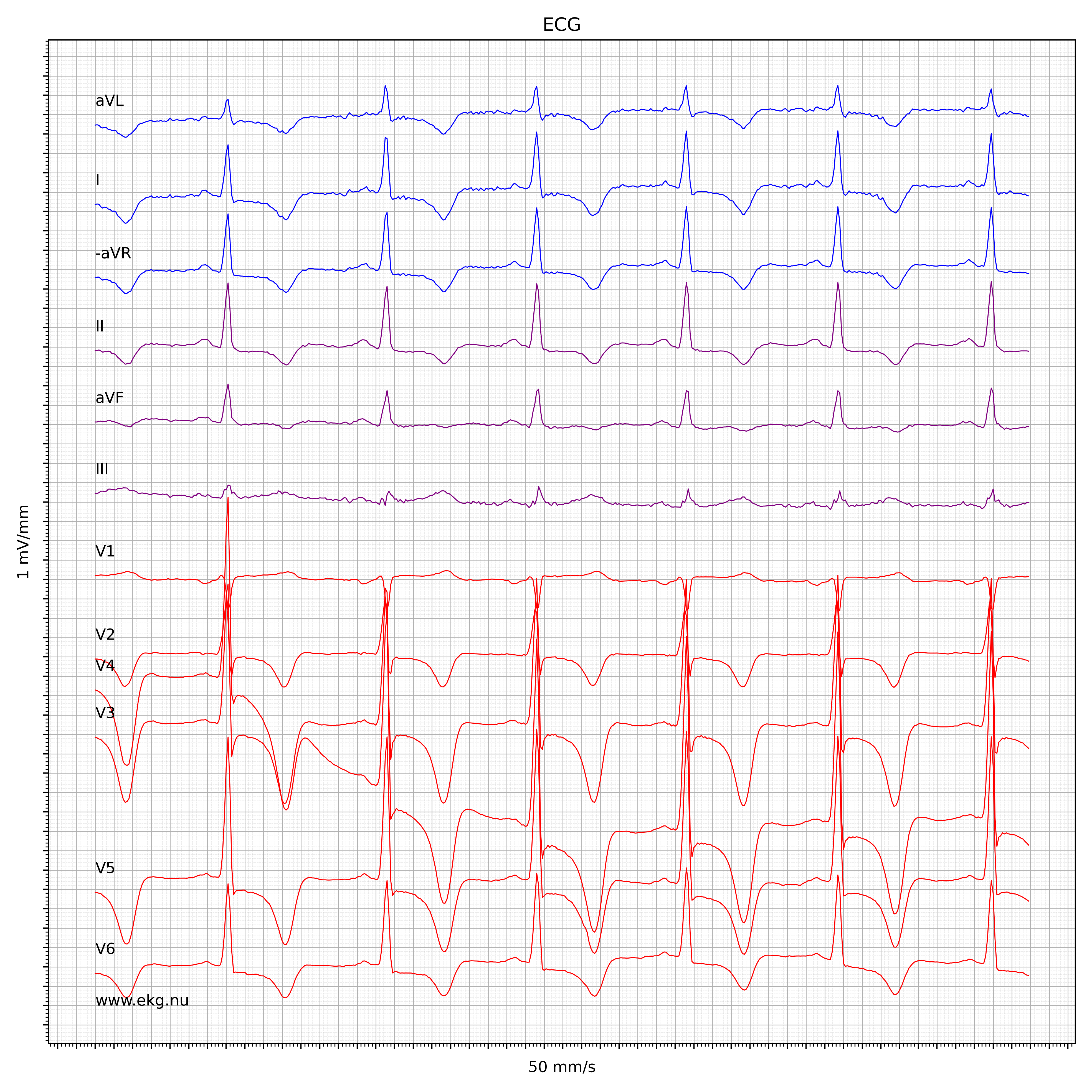 EKG test tolkning 319218118