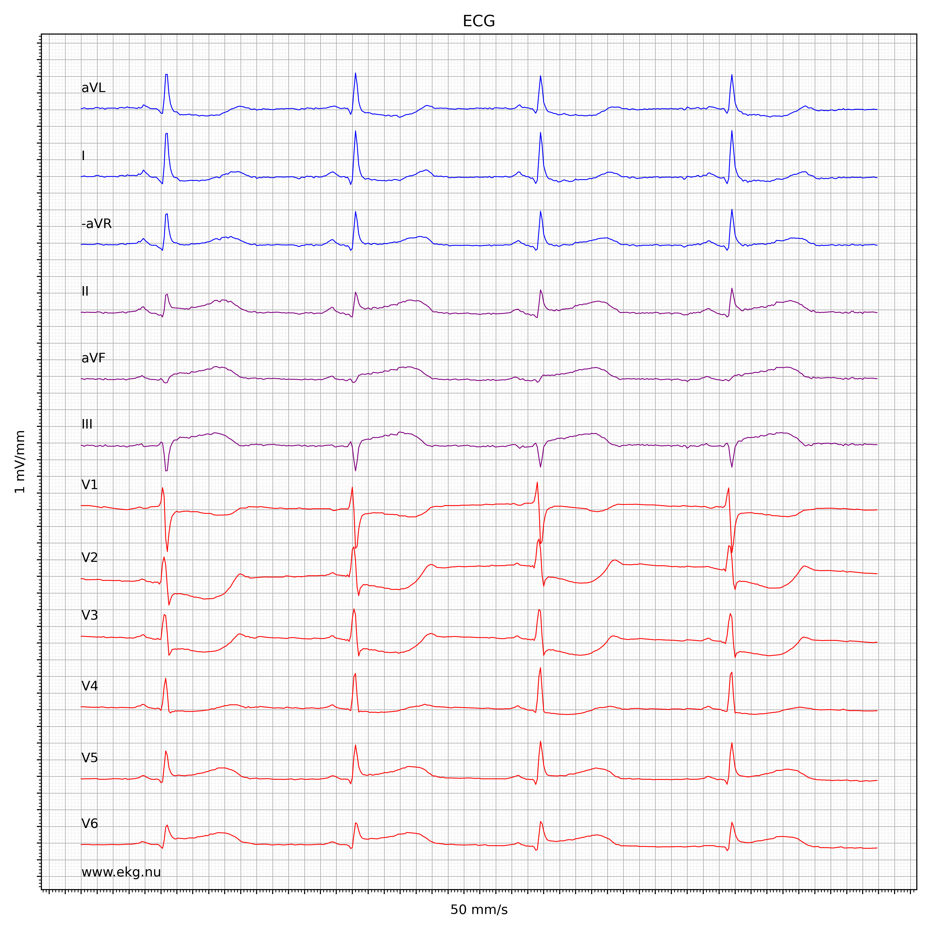 EKG test tolkning 31922993
