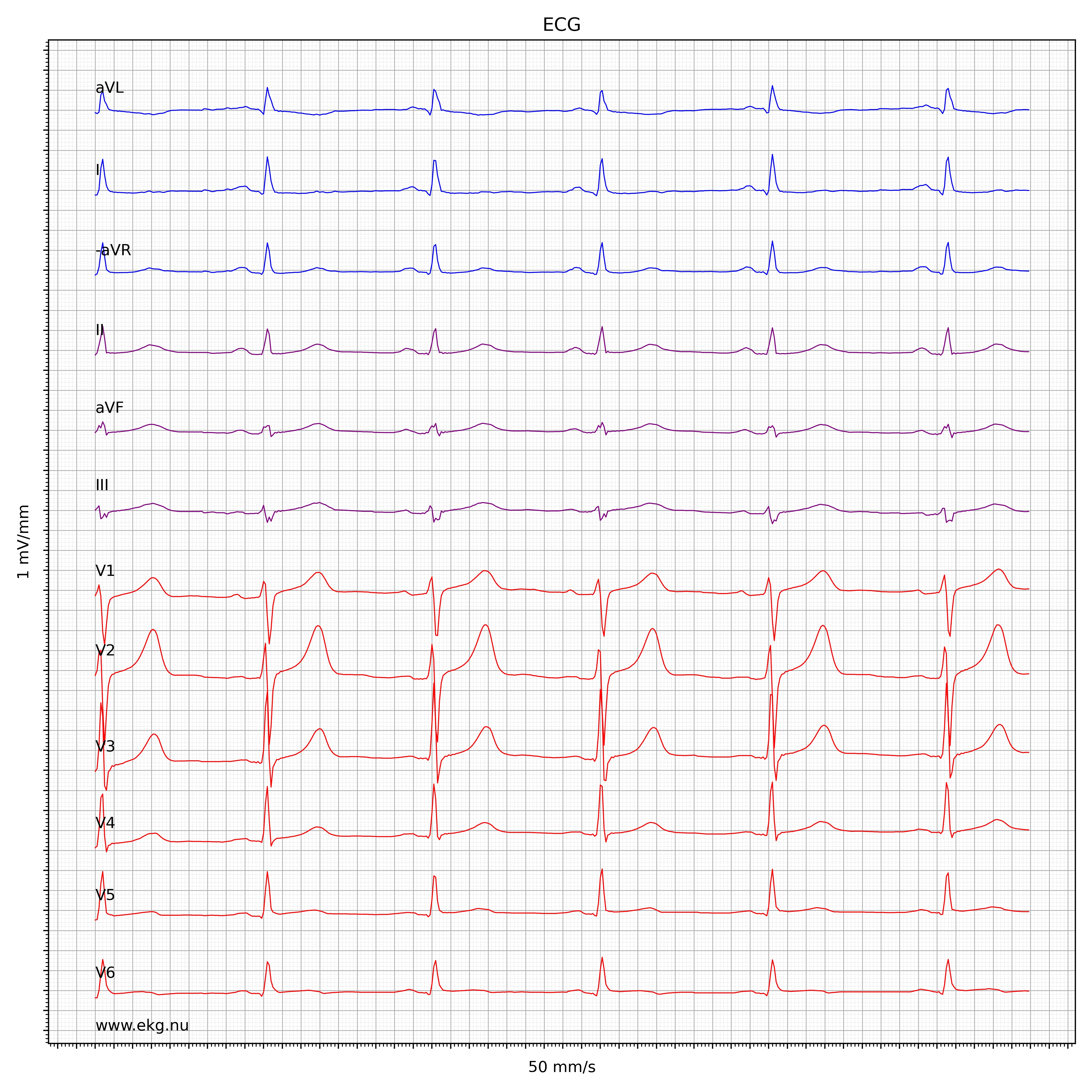 EKG test tolkning 31924741