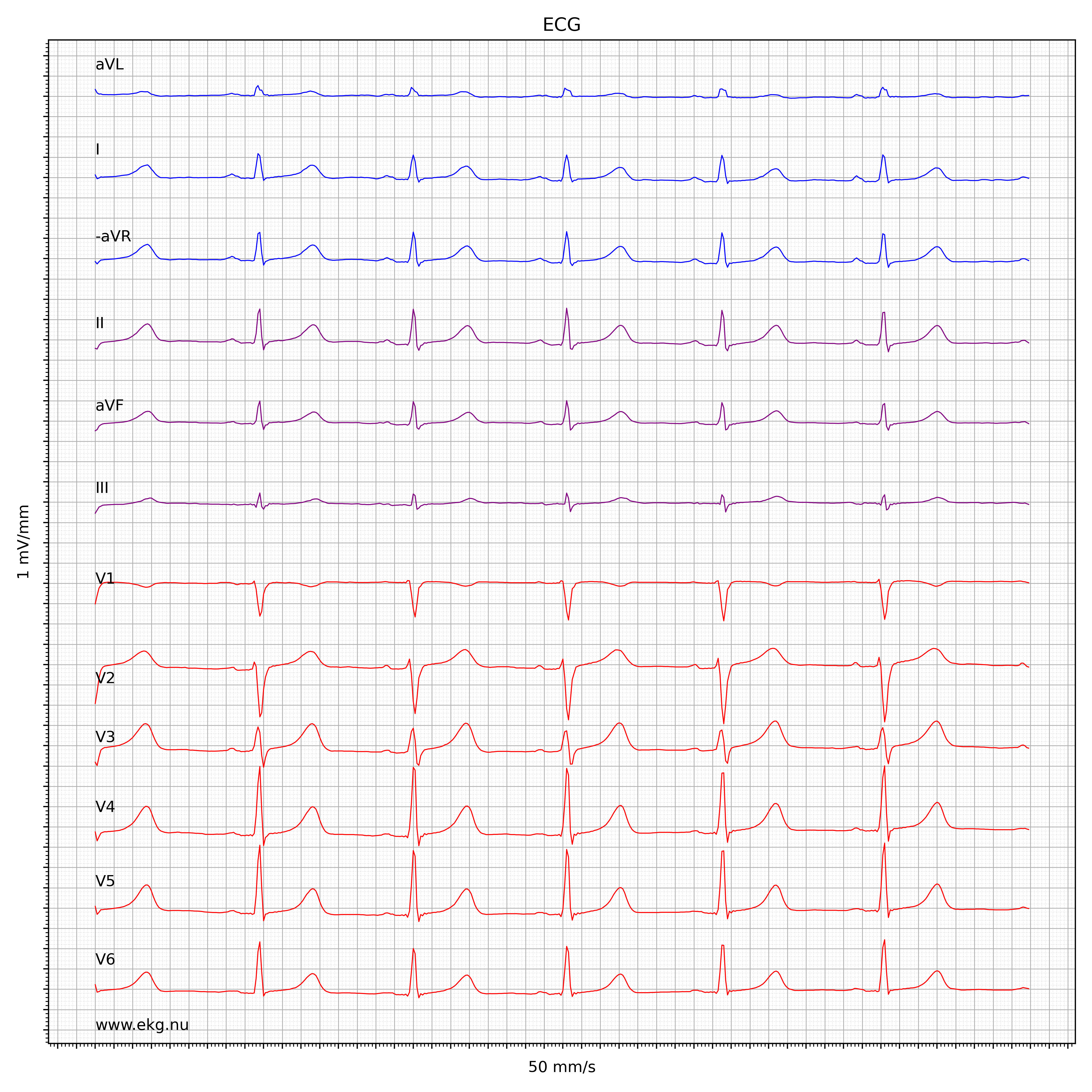 EKG test tolkning 31925744