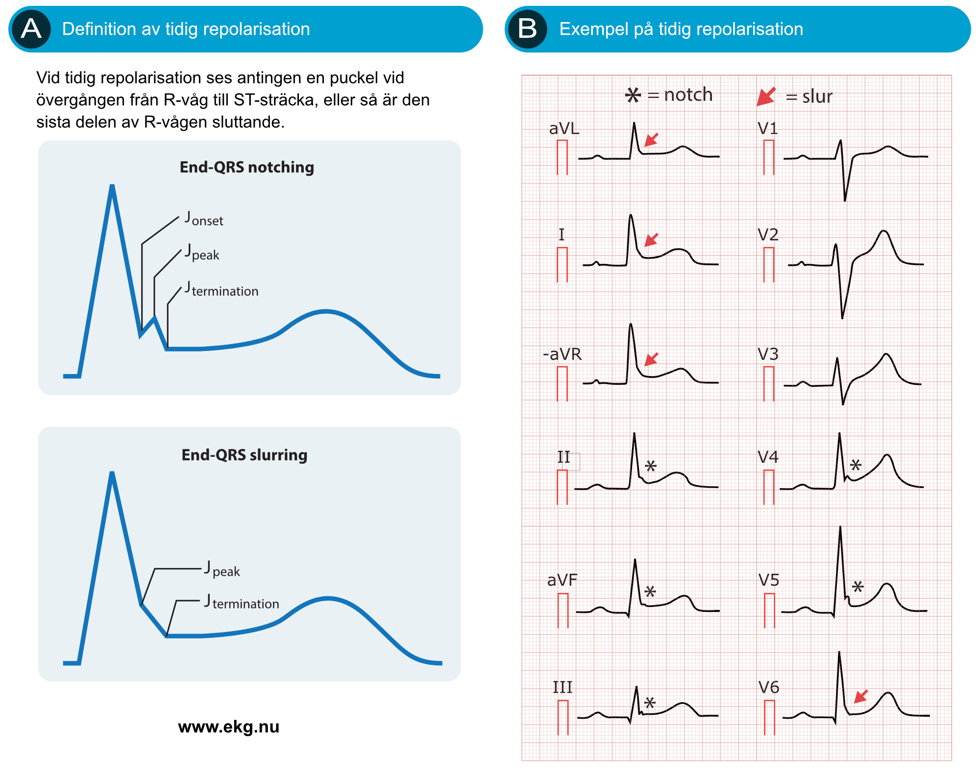 Figur 75. Early repolarization (tidig repolarisation). Efter MacFarlane et al.