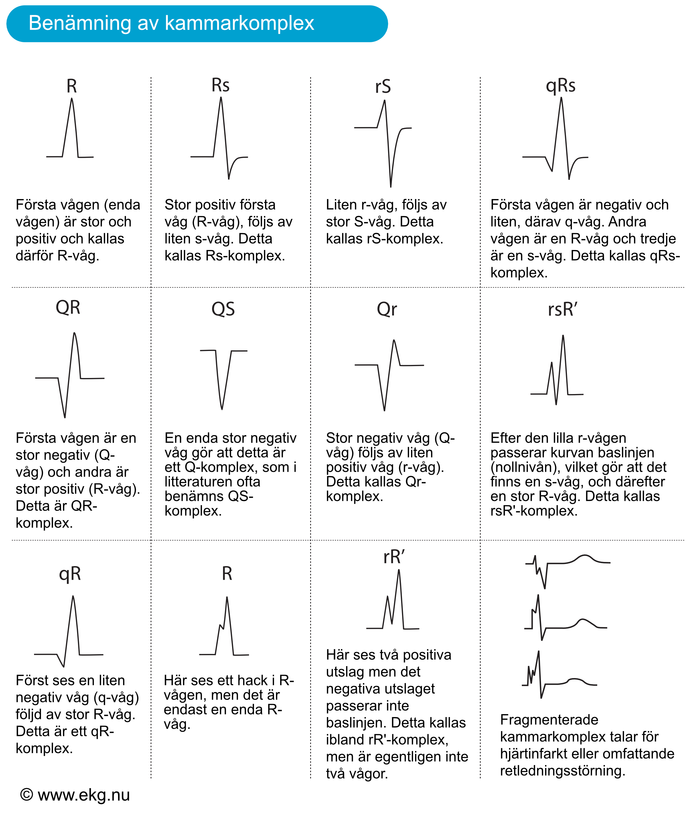 Figur 5. Benämning av EKG-kurvans kammarkomplex (QRS-komplex).