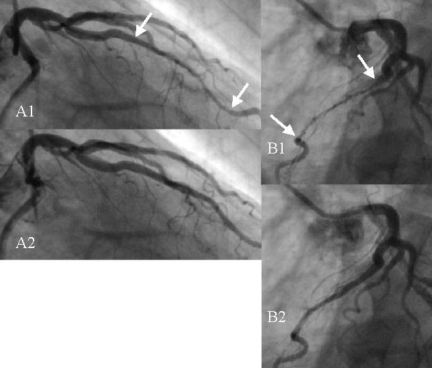 Figur 1. Myocardial bridge