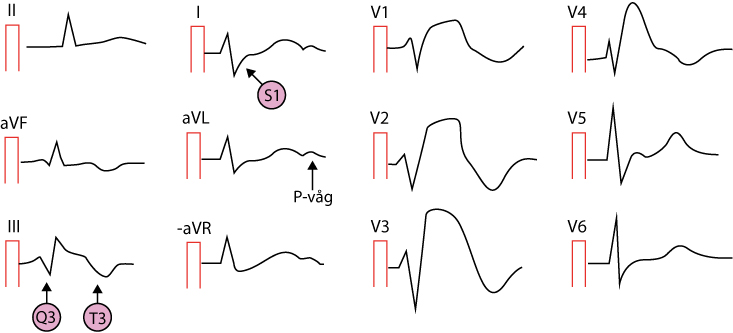 EKG med lungemboli (S1Q3T3-mönster)
